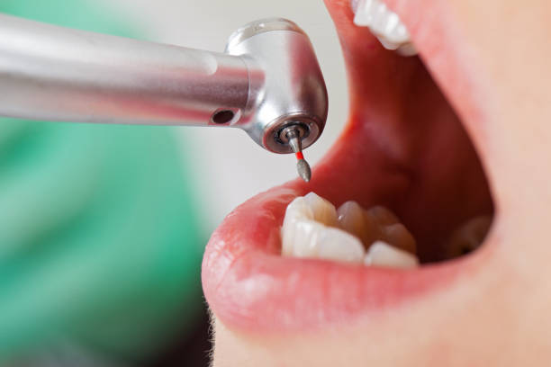 Best Emergency Dental Care for Broken or Chipped Teeth in Amelia, LA